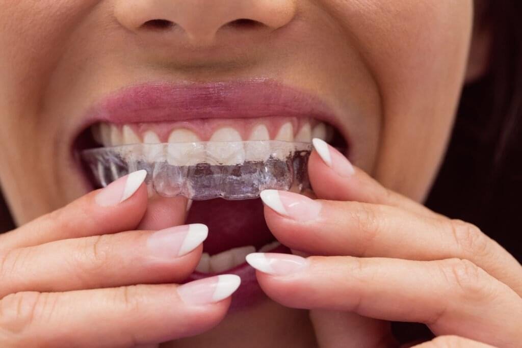 Woman placing clear aligners in Dubai during orthodontic treatment